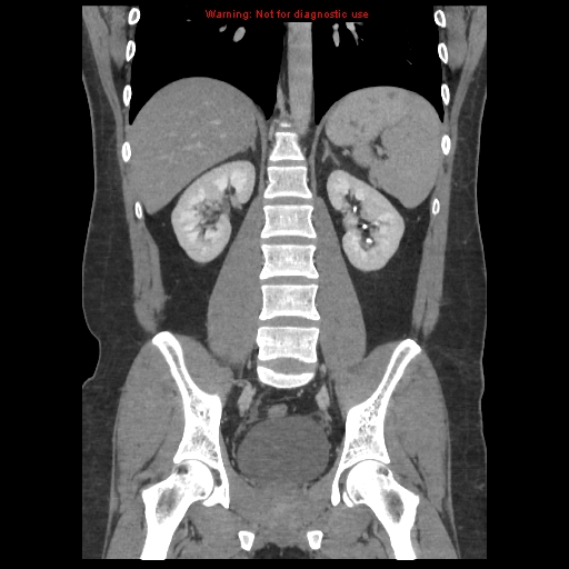 File:Acute appendicitis (Radiopaedia 10498-10973 F 31).jpg
