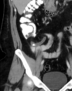 File:Acute appendicitis (Radiopaedia 12326-12607 Coronal C+ portal venous phase 1).jpg
