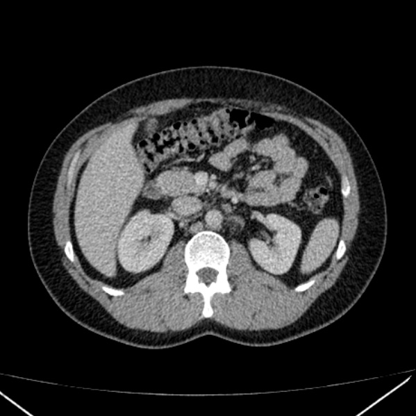 Acute appendicitis (Radiopaedia 38255-40270 Axial C+ portal venous phase 39).jpg