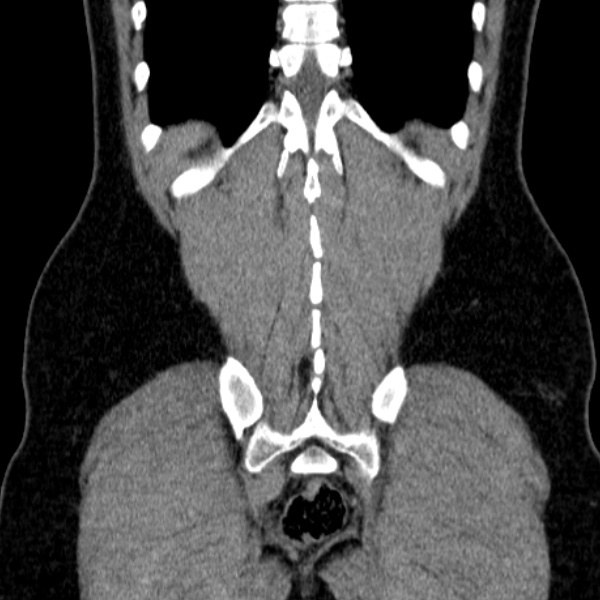 File:Acute appendicitis (Radiopaedia 38255-40270 Coronal C+ portal venous phase 74).jpg