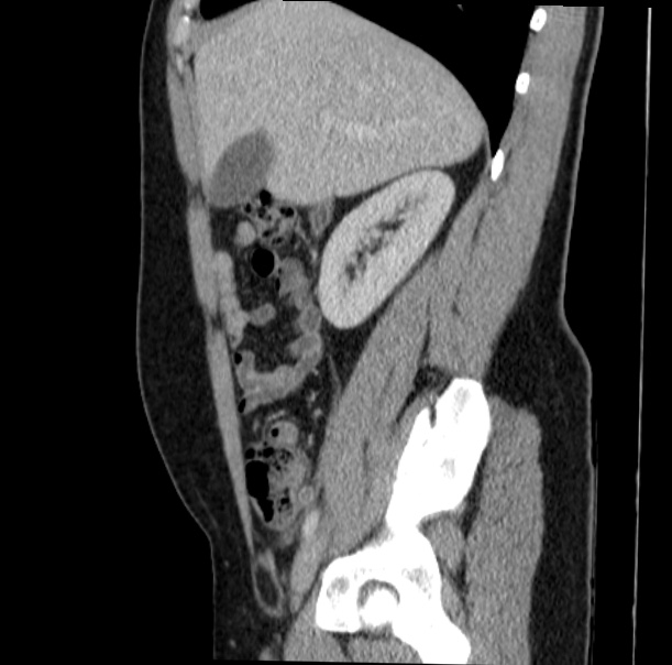 Acute appendicitis (Radiopaedia 38255-40270 Sagittal C+ portal venous phase 27).jpg