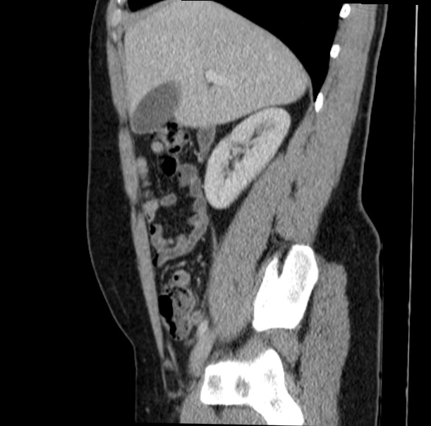 Acute appendicitis (Radiopaedia 38255-40270 Sagittal C+ portal venous phase 28).jpg
