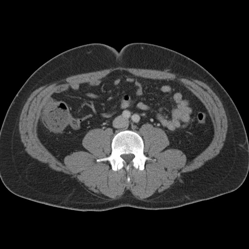 Acute appendicitis (Radiopaedia 48511-53463 Axial C+ portal venous phase 60).jpg
