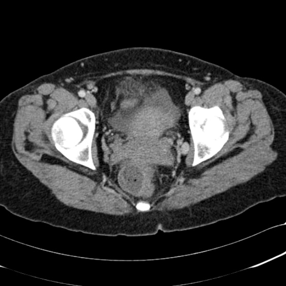 Acute appendicitis (Radiopaedia 48792-53822 Axial C+ portal venous phase 109).jpg