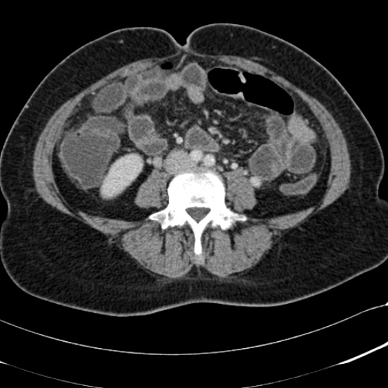 File:Acute appendicitis (Radiopaedia 48792-53822 Axial C+ portal venous phase 67).jpg