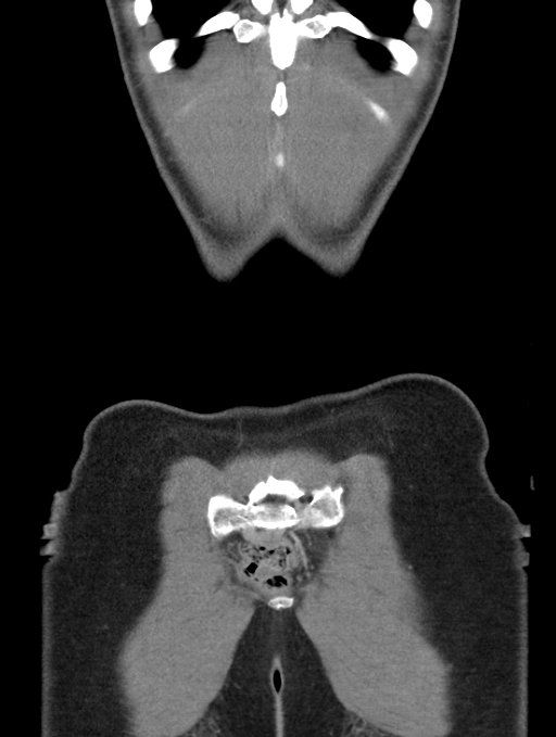 Acute appendicitis (Radiopaedia 62608-70901 Coronal C+ portal venous phase 60).jpg