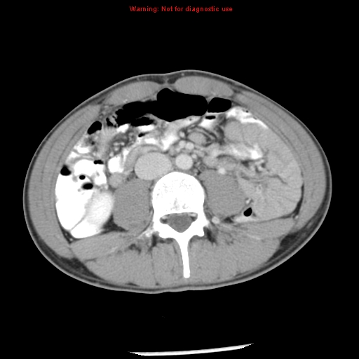 Acute appendicitis (Radiopaedia 8195-9045 Axial C+ portal venous phase 40).jpg