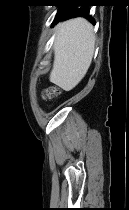 Acute appendicitis - large appendicoliths (Radiopaedia 61805-69820 Sagittal C+ portal venous phase 102).jpg