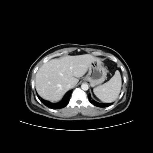 Acute appendicitis and COVID 19 pneumonia (Radiopaedia 76604-88380 Axial C+ portal venous phase 14).jpg