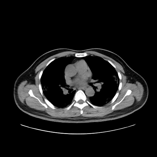 Acute appendicitis and COVID 19 pneumonia (Radiopaedia 76604-88380 Axial non-contrast 26).jpg