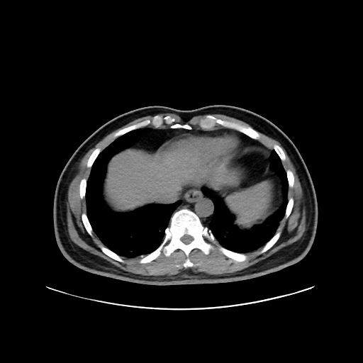 Acute appendicitis and COVID 19 pneumonia (Radiopaedia 76604-88380 Axial non-contrast 45).jpg