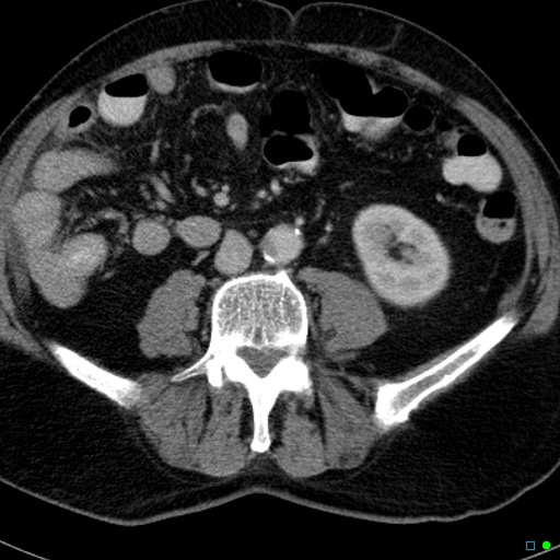 File:Acute appendicitis arising from a malrotated cecum (Radiopaedia 19970-19997 Axial C+ portal venous phase 20).jpg