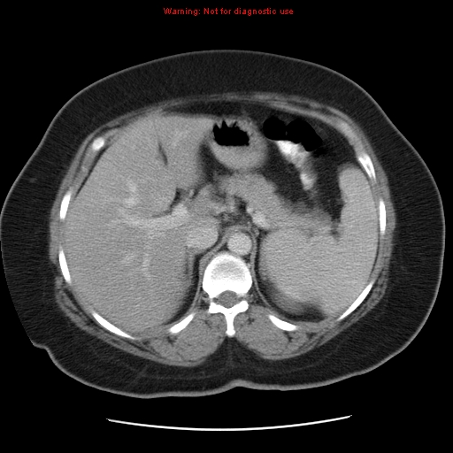 Acute appendicitis complicated by ovarian vein thrombophlebitis (Radiopaedia 16172-15851 Axial C+ portal venous phase 27).jpg