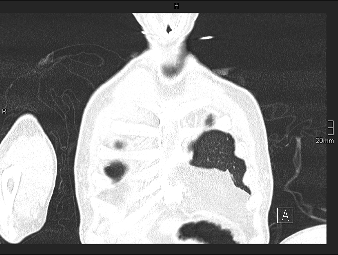 Acute aspiration pneumonitis (Radiopaedia 55642-62166 Coronal lung window 9).jpg