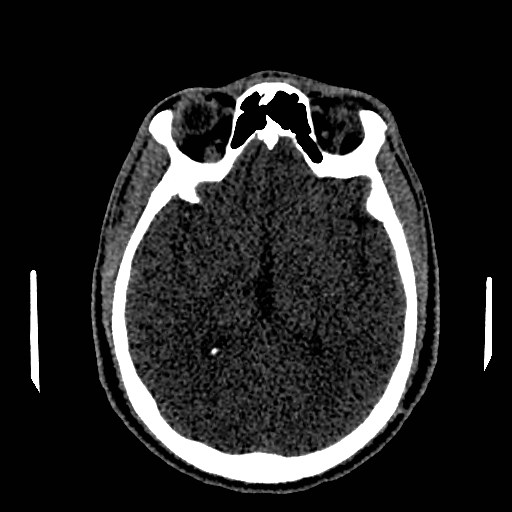 File:Acute basilar artery occlusion (Radiopaedia 43582-46985 Axial non-contrast 93).jpg