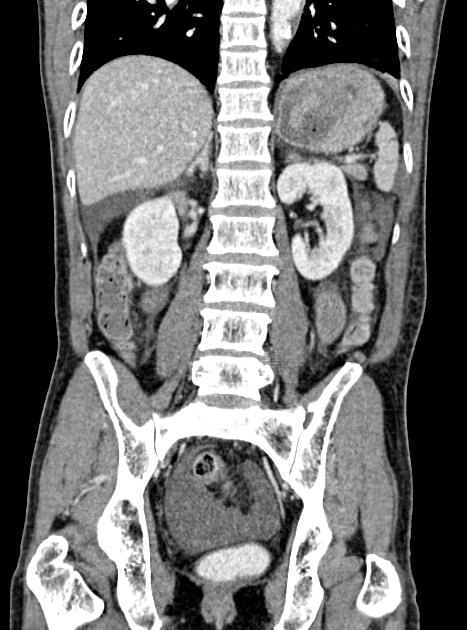 Acute bowel ischemia (Radiopaedia 87695-104114 Coronal C+ portal venous phase 257).jpg