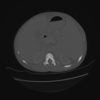 File:Acute calculous cholecystitis in patient with osteopetrosis (Radiopaedia 77871-90159 Axial bone window 17).jpg