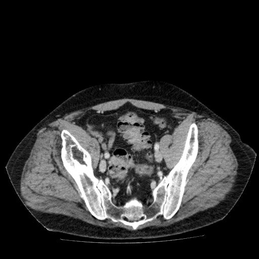 Acute cholecystitis and incidental left sided IVC (Radiopaedia 49352-54459 Axial C+ portal venous phase 127).jpg