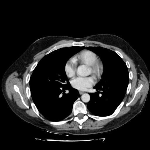 File:Acute cholecystitis and incidental left sided IVC (Radiopaedia 49352-54459 Axial C+ portal venous phase 8).jpg