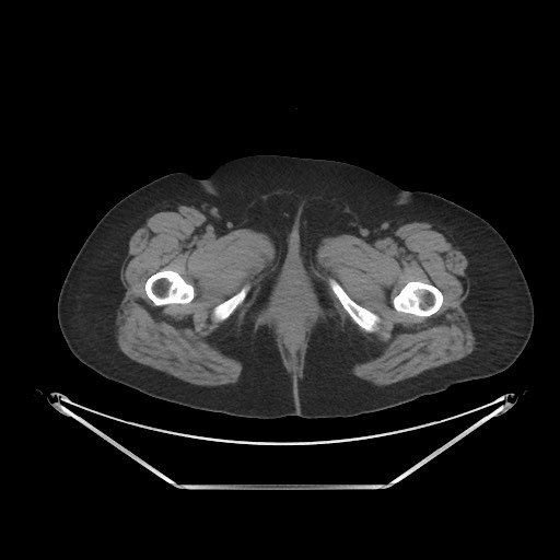 Acute cholecystitis with tensile fundus sign (Radiopaedia 71394-81723 Axial non-contrast 131).jpg