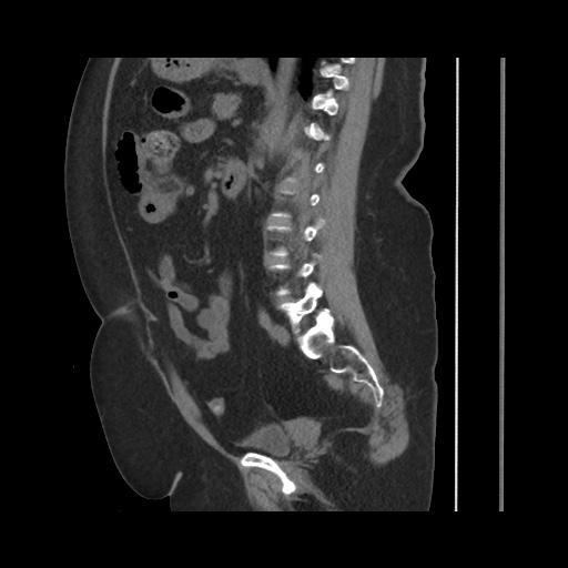 Acute cholecystitis with tensile fundus sign (Radiopaedia 71394-81723 Sagittal non-contrast 99).jpg
