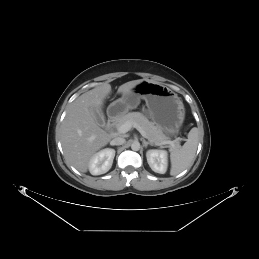 File:Acute complicated calculous cholecystitis (Radiopaedia 55202-61587 Axial C+ delayed 34).jpg