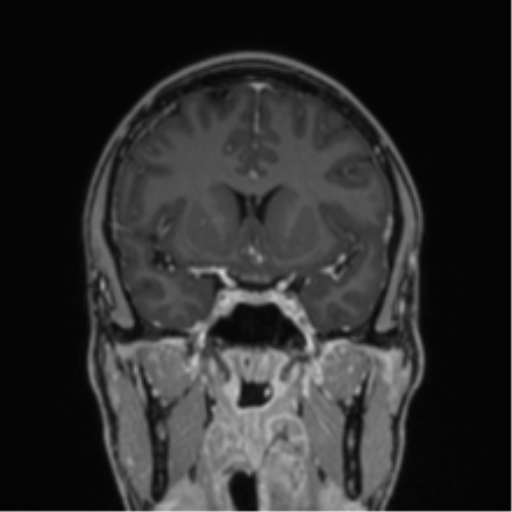 File:Acute disseminated encephalomyelitis (ADEM) (Radiopaedia 65319-74349 Coronal T1 C+ 34).png