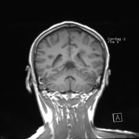 File:Acute disseminated encephalomyelitis (Radiopaedia 37253-39033 Coronal T1 18).jpg