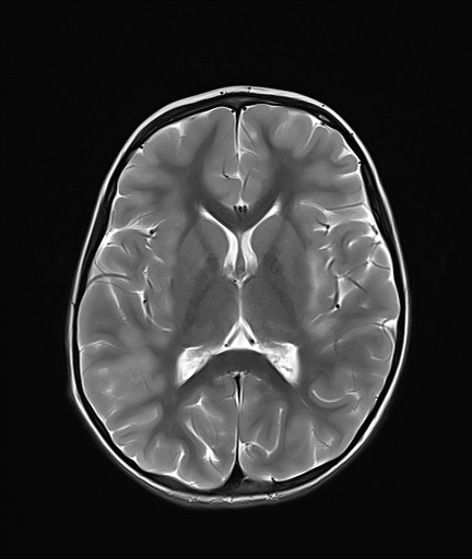 File:Acute disseminating encephalomyelitis with bilateral optic neuritis (Radiopaedia 79676-92886 Axial T2 14).jpg