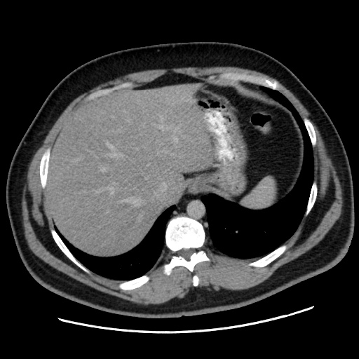 File:Acute diverticulitis with localized perforation (Radiopaedia 41296-44113 Axial C+ portal venous phase 17).jpg