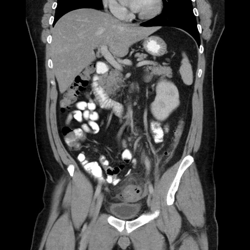 Acute diverticulitis with localized perforation (Radiopaedia 41296-44113 Coronal C+ portal venous phase 31).jpg