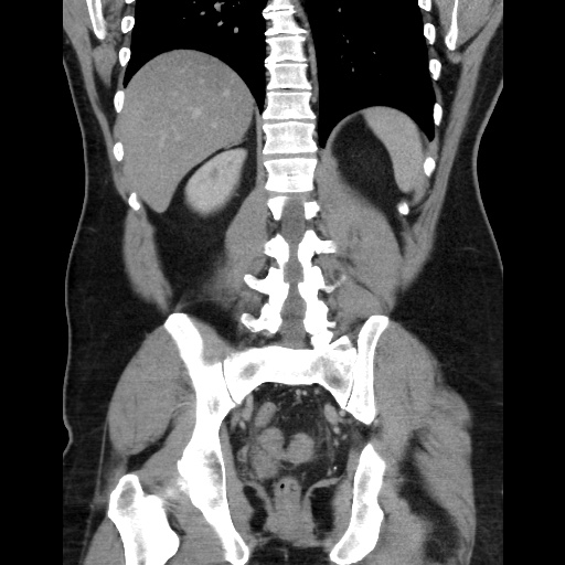 Acute diverticulitis with localized perforation (Radiopaedia 41296-44113 Coronal C+ portal venous phase 45).jpg