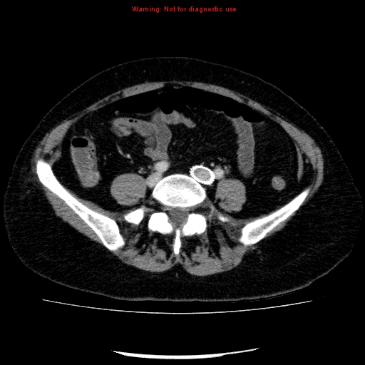 File:Acute gangrenous cholecystitis (Radiopaedia 10123-10661 Axial C+ portal venous phase 71).jpg