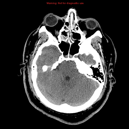 Acute hemorrhagic leukoencephalitis (Radiopaedia 14076-13920 Axial non-contrast 13).jpg
