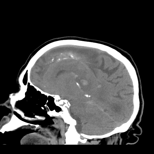 File:Acute hemorrhagic stroke (Radiopaedia 17507-17223 Sagittal non-contrast 26).jpg