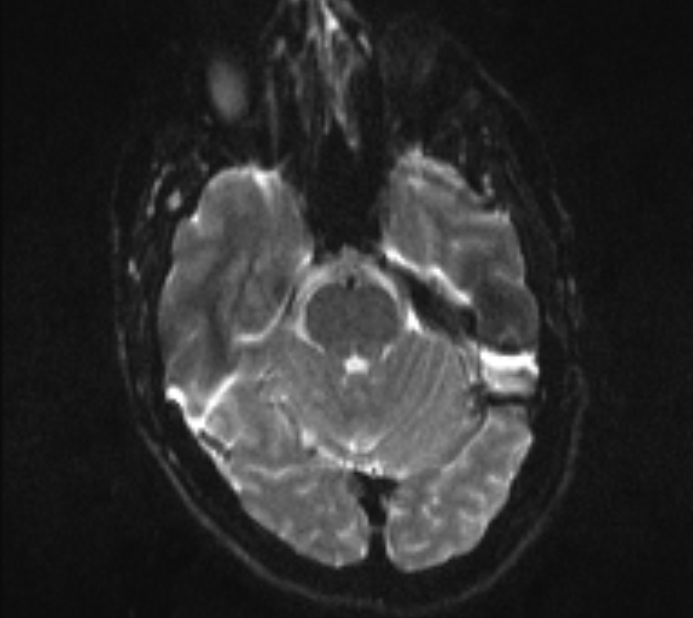 Acute ischemic stroke - posterior circulation territory (Radiopaedia 77670-89880 Axial DWI 8).jpg