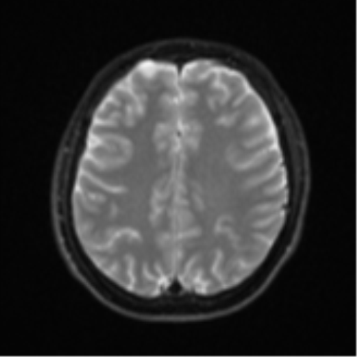 Acute left middle cerebral artery territory infarct with clot retrieval (Radiopaedia 47732-52433 Axial DWI 21).png