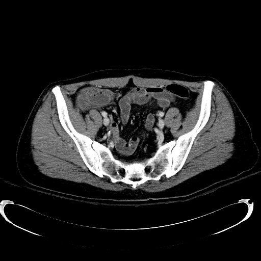 File:Acute myocardial infarction in CT (Radiopaedia 39947-42415 Axial C+ portal venous phase 103).jpg