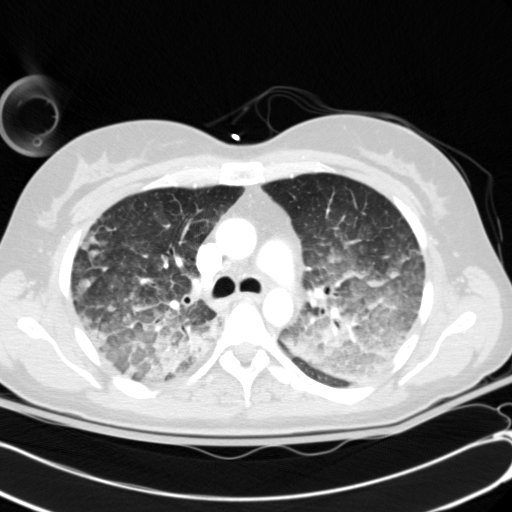 Acute myocardial infarction in CT (Radiopaedia 39947-42415 Axial lung window 44).jpg