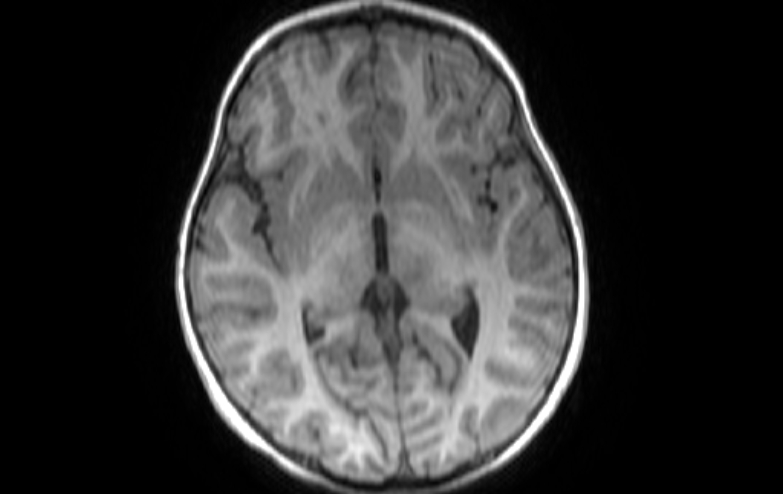 Acute necrotizing encephalitis of childhood (Radiopaedia 67356-76737 Axial T1 50).jpg