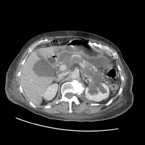 Acute on chronic pancreatitis (Radiopaedia 13233-13244 Axial C+ portal venous phase 33).jpg