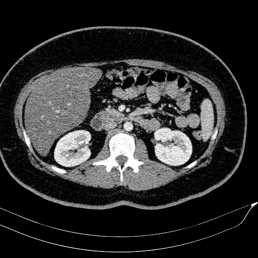 Acute on chronic pancreatitis (Radiopaedia 80902-94423 Axial C+ portal venous phase 77).jpg