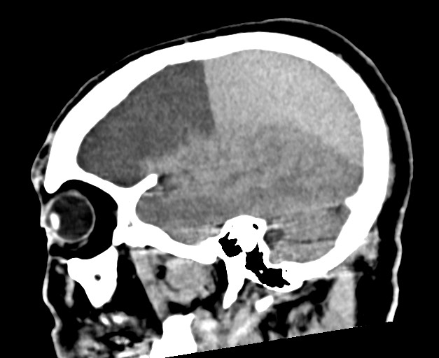 Acute on chronic subdural hematoma (Radiopaedia 78346-90966 Sagittal non-contrast 43).jpg