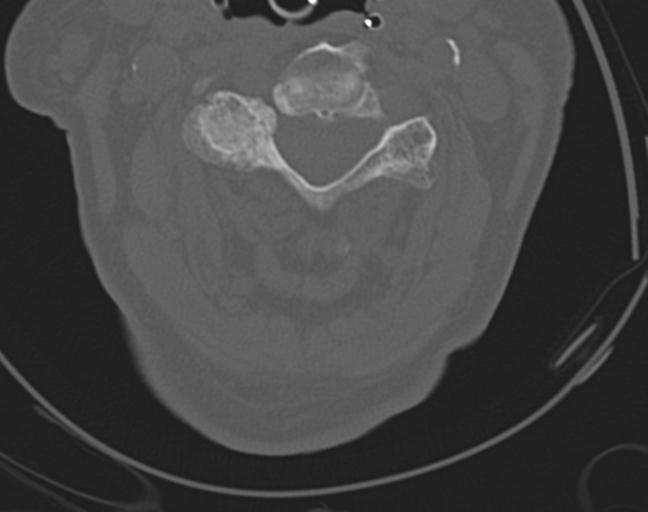 Acute on chronic subdural hematoma and thoracic vertebral injury in a multitrauma patient (Radiopaedia 31698-32619 Axial bone window 27).jpg