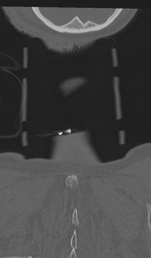 Acute on chronic subdural hematoma and thoracic vertebral injury in a multitrauma patient (Radiopaedia 31698-32619 Coronal bone window 75).jpg