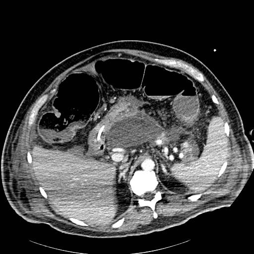 File:Acute pancreatic necrosis (Radiopaedia 13560-18502 Axial C+ portal venous phase 17).jpg