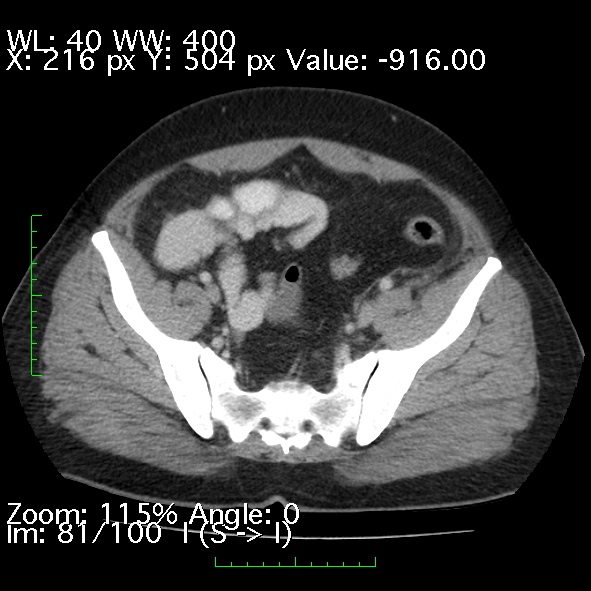 Acute pancreatitis (Radiopaedia 34043-35276 Axial C+ portal venous phase 81).jpg