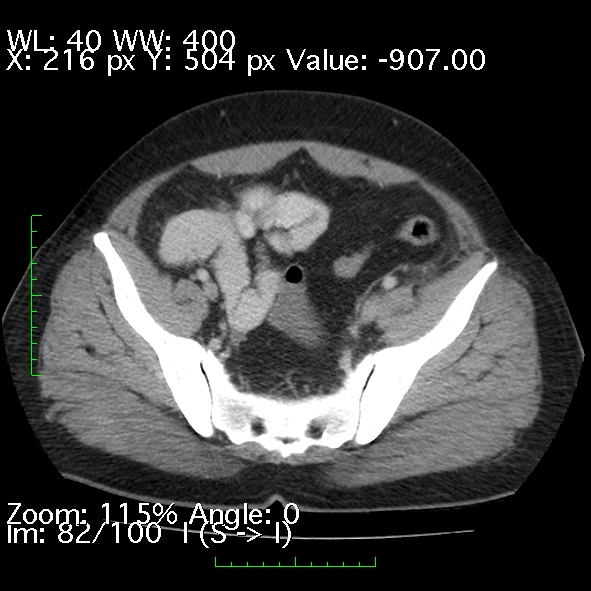 Acute pancreatitis (Radiopaedia 34043-35276 Axial C+ portal venous phase 82).jpg