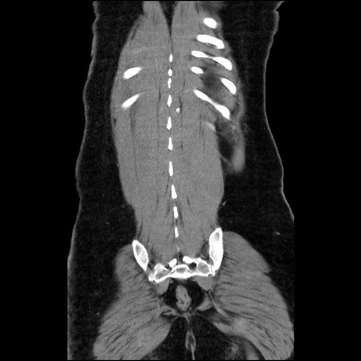 Acute pancreatitis (Radiopaedia 69236-79012 Coronal C+ portal venous phase 19).jpg