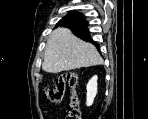 Acute pancreatitis (Radiopaedia 85146-100701 Sagittal C+ portal venous phase 13).jpg